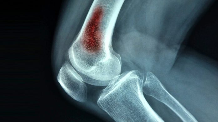 Tempat Pengobatan Osteomielitis atau Infeksi Tulang di Jakarta Profesional