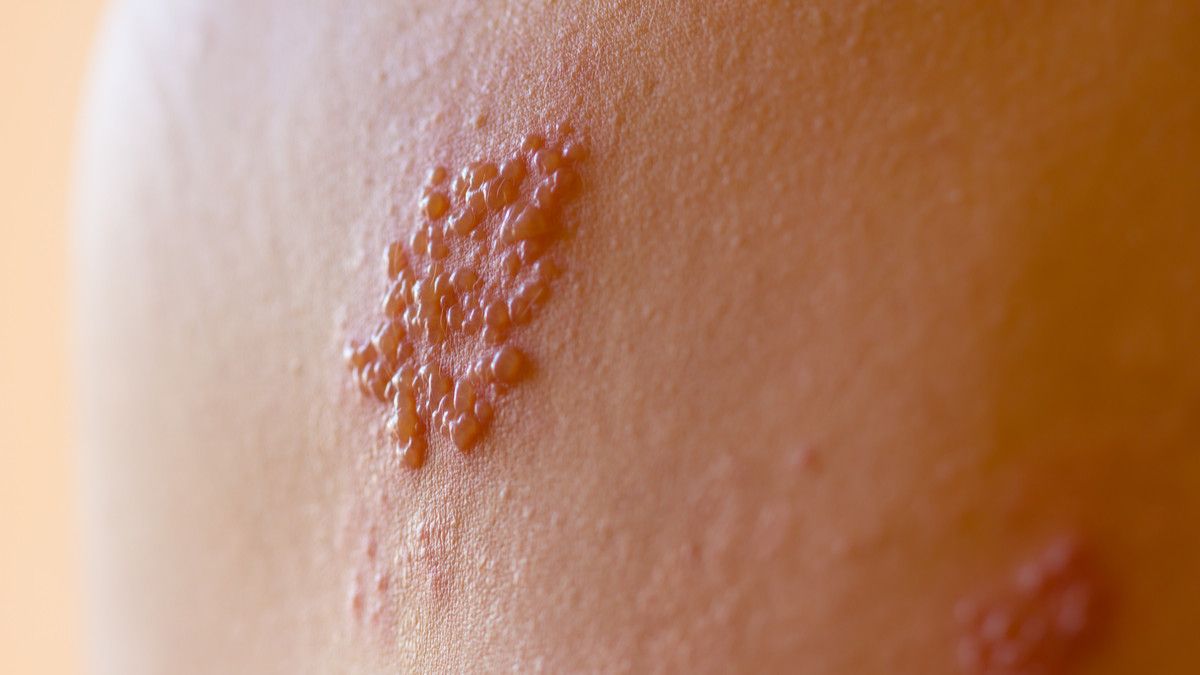 Tempat Pengobatan Herpes Zoster di Tangerang Paling Nyaman dan Populer