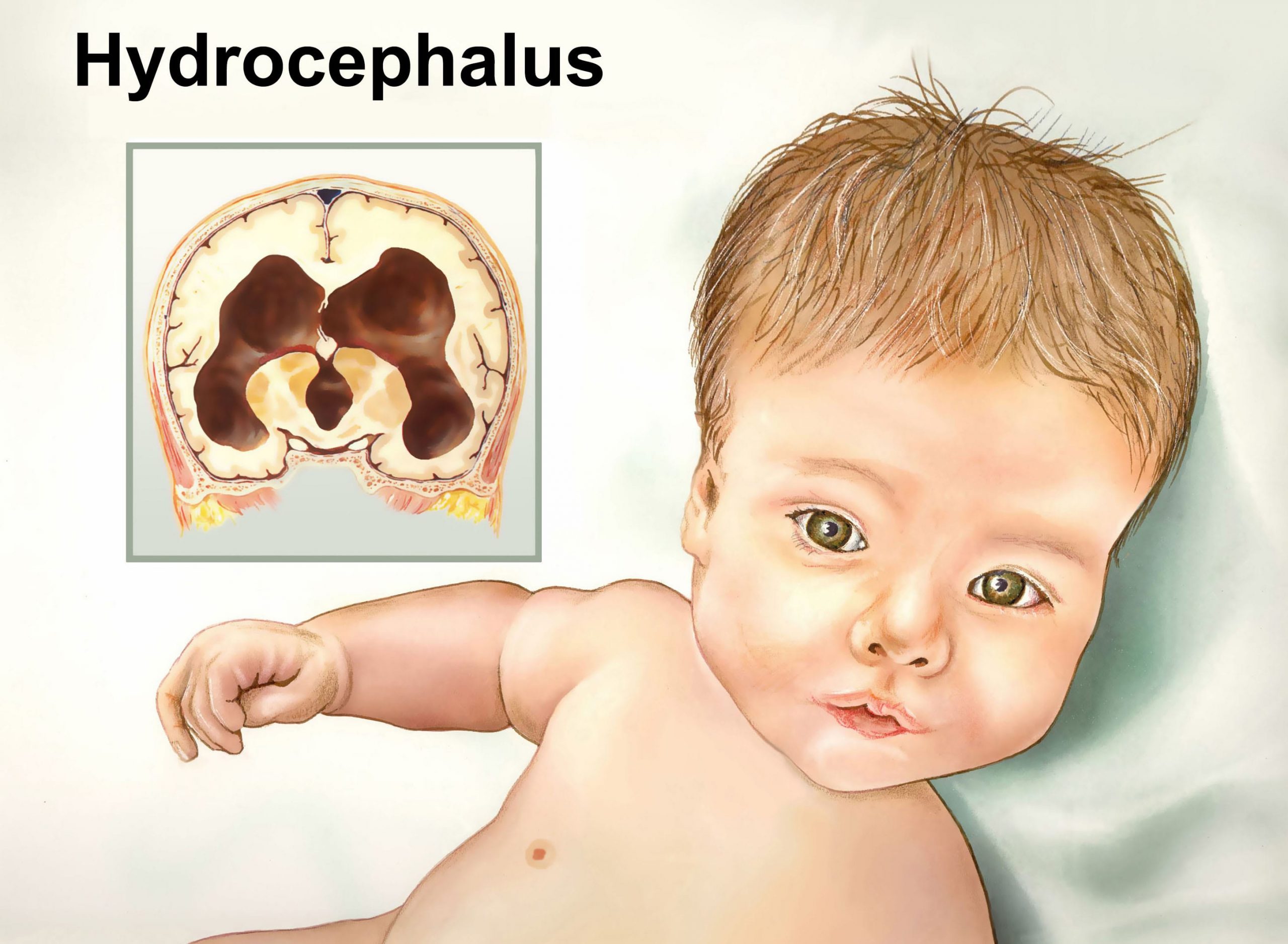 Поражение головного мозга у новорожденных. Гидроцефалия головного мозга у ребенка. Внутренняя гидроцефалия головного мозга у грудничка. Гидроцефалия головного мозга синдромы у ребенка. Гидроцефалия врождённая у плода.