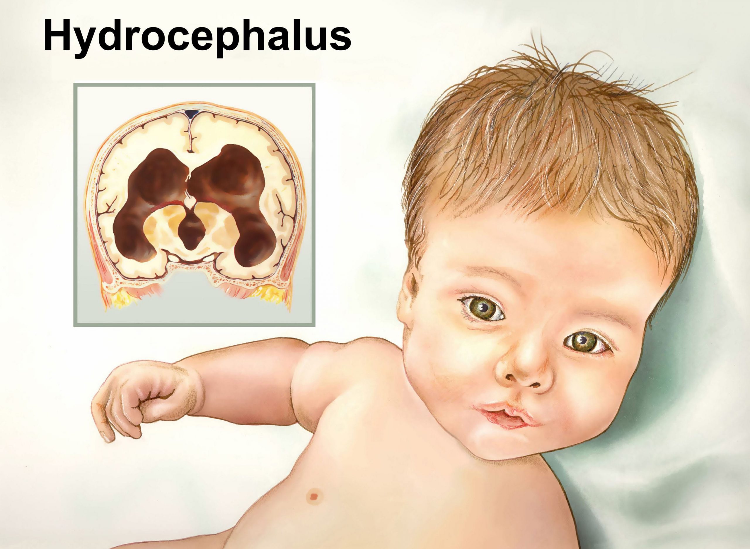 Нарушение развития головного мозга. Гидроцефалия головного мозга у ребенка. Внутренняя гидроцефалия головного мозга у грудничка. Гидроцефалия головного мозга синдромы у ребенка. Гидроцефалия врождённая у плода.