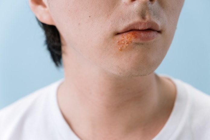 Tempat Pengobatan Herpes Zoster di Bintaro Terpopuler