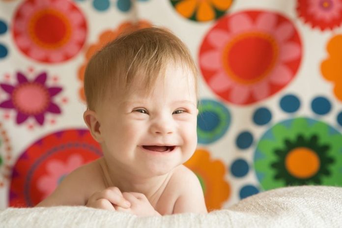 Tempat Pengobatan Down Syndrome di Bintaro Terpercaya