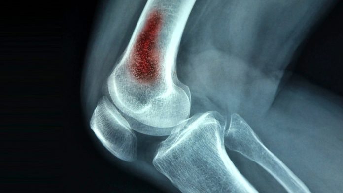 Tempat Pengobatan Osteomielitis Atau Infeksi Tulang di Bintaro Paling Populer