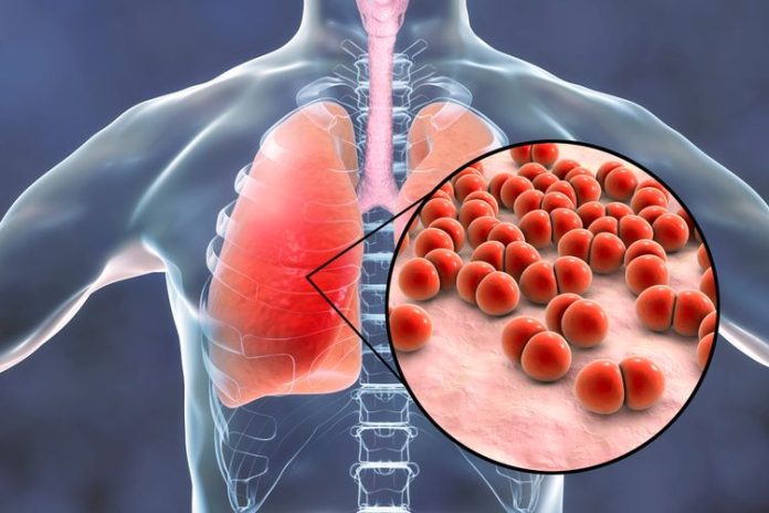 Tempat Pengobatan Pneumonia di Bintaro yang Bagus