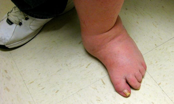 Mengenal Charcot Foot atau Kaki Charcot Secara Mendalam