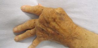 Rematik atau Rheumatoid Arthritis (RA): Gejala, Penyebab dan Solusinya
