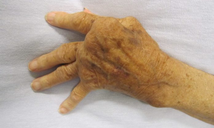 Rematik atau Rheumatoid Arthritis (RA): Gejala, Penyebab dan Solusinya