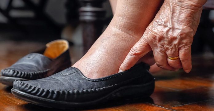 Tempat Pengobatan Charcot Joint Atau Sendi Charcot di Cibitung Tanpa Obat Kimia