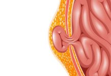 Tempat Pengobatan Hernia di Cikarang Tanpa Operasi