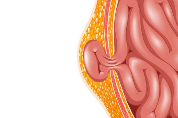 Tempat Pengobatan Hernia di Cikarang Tanpa Operasi