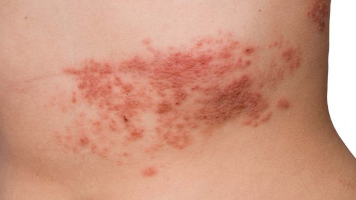 Tempat Pengobatan Herpes Zoster di Cikarang Paling Aman