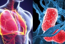Tempat Pengobatan Pneumonia di Cibitung Tanpa Operasi