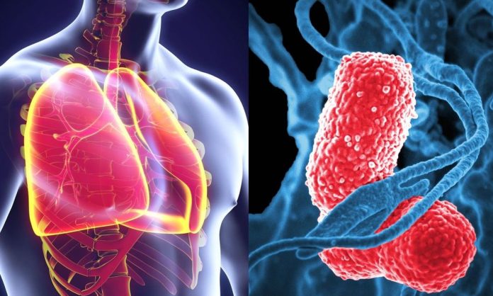 Tempat Pengobatan Pneumonia di Cibitung Tanpa Operasi
