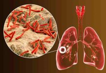 Tempat Pengobatan TBC di Cibitung Tanpa Obat Kimia