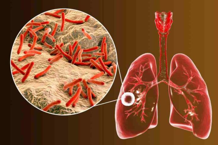 Tempat Pengobatan TBC di Cibitung Tanpa Obat Kimia