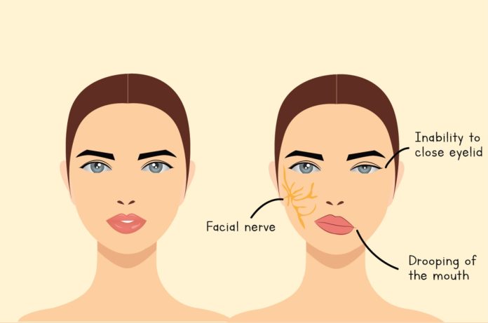 Tempat Pengobatan Virus Belpasi Atau Bell’s Palsy di Cibitung Tanpa Obat