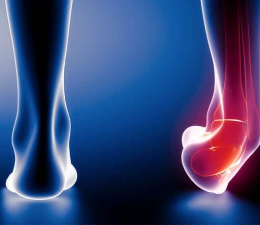 Terapi Keseleo Tulang di Cikarang Paling Nyaman dan Cepat Sembuh