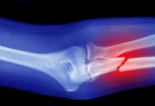 Terapi Patah Tulang di Cikarang Paling Aman dan Nyaman