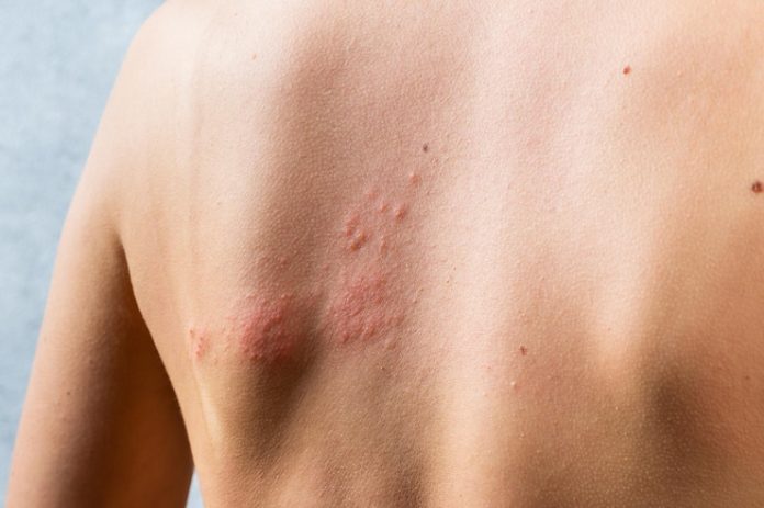 Tempat Pengobatan Herpes Zoster di Bangkinang Paling Mujarab dan Aman