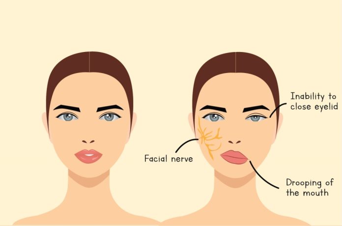 Tempat Pengobatan Virus Belpasi Atau Bell’s Palsy di Bangkinang yang Aman dan Nyaman