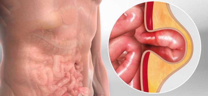 Tempat Pengobatan Hernia di Cibitung Terpercaya dan Mujarab