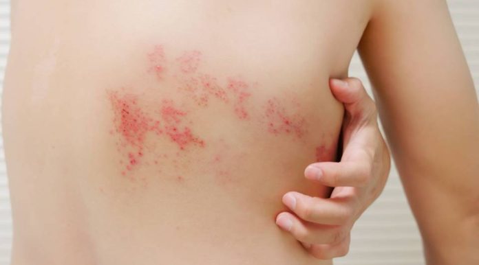 Tempat Pengobatan Herpes Zoster di Bangkinang yang Mujarab Tanpa Efek Samping