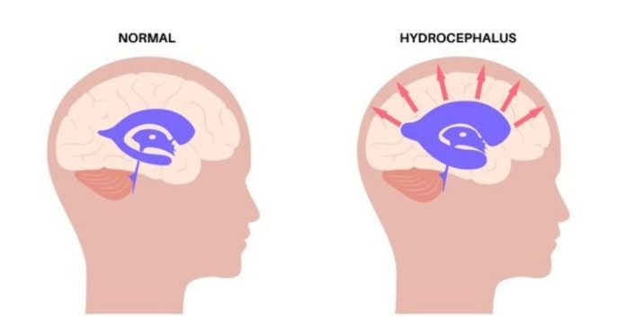 Tempat Pengobatan Hidrocephalus di Bangkinang yang Paling Aman dan Nyaman