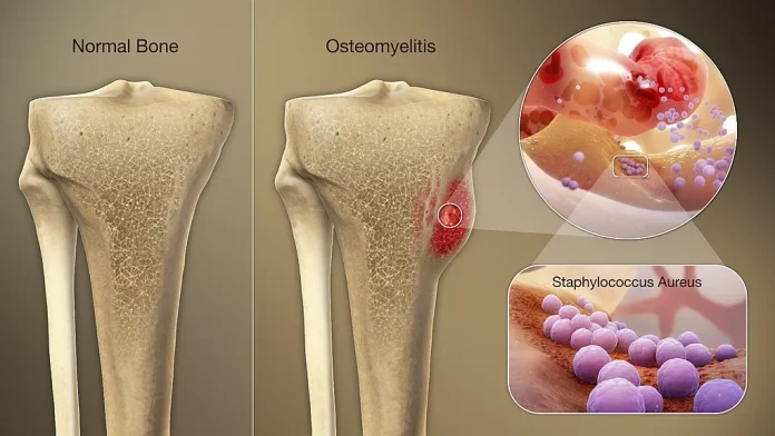 Tempat Pengobatan Osteomielitis atau Infeksi Tulang di Cibitung