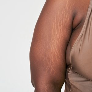 Ini Dia Pengobatan Stretch Mark Untuk Membantu Kulit Mulus Kembali