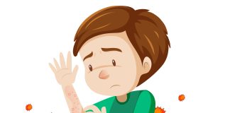 Monkeypox Menghebohkan Indonesia Ini Solusinya
