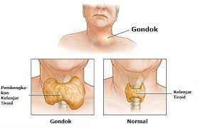 gondok medhack