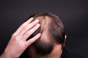 rambut rontok medhack