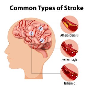 Kisah Inspiratif Pejuang Stroke dengan 3 Treatment Penyembuhan