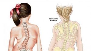 Hasil Ibu Ini Terapi Keluhan Skoliosis Di Medical Hacking