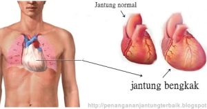 Ikhtiar Seorang Ibu Menjalani Terapi Jantung