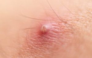 Jenis Penyakit Kulit dan Tips Mudah Mengatasinya dengan Bahan Alami