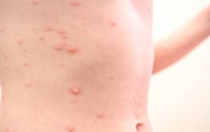 Jenis Penyakit Kulit dan Tips Mudah Mengatasinya dengan Bahan Alami
