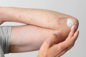 Jenis Penyakit Kulit dan Tips Mudah Mengatasinya dengan Bahan Alami