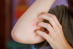 Jenis Penyakit Kulit dan Tips Mudah Mengatasinya dengan Bahan Alami