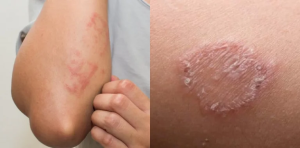 Jenis Penyakit Kulit dan Tips Mudah Mengatasinya dengan Bahan Alami